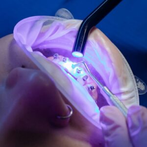 Close-up of a dental procedure using a UV light on braces for orthodontic treatment.